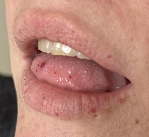 Teleangiektasie Beispiel 1